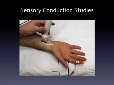 sensory nerve conduction study